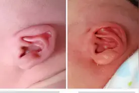 宝宝耳廓畸形怎么办？这种治疗你想不到图片