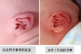 宝宝耳廓畸形怎么办？这种治疗你想不到图片