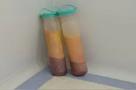 网红吸脂感染去世，专家告诉你关于吸脂的真相图片