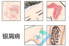 “牛皮癣”你了解多少？图片