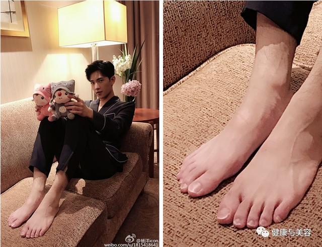 标准的脚趾甲李现日常应该是经常过度剪趾甲,可以看到脚拇指的趾甲