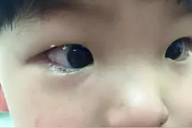 5岁宝宝眼睛“看不见了”，家人以为没睡好，检查后医生：来晚了图片