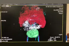 小悦悦手术背后的故事：不能根治的手术，为什么还要做？图片