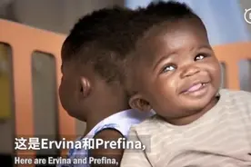 医学奇迹！2岁连体双胞胎在意大利成功分离，曾头颅相连共用血管图片