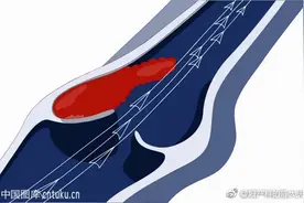 短效口服避孕药会导致血栓吗？图片