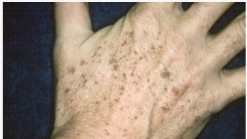 脂溢性角化症大蒜