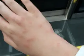 小心！这种吸血小虫比蚊子毒10倍，被咬后痒到钻心图片