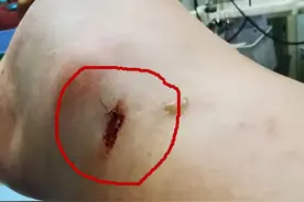 吓人！浙江男子被烙铁头蛇咬后成功自救，咬一口有多毒？够死两回图片