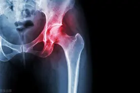 股骨头坏死，原因是什么？骨科教授：治疗股骨头坏死，根源是关键图片