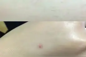 同样被蚊子咬，大肿包代表身体虚，小红点说明身体好？图片