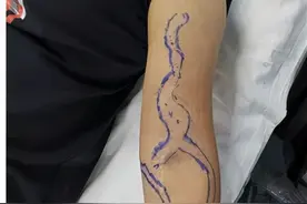 肾脏完全“罢工”，广西一女子靠透析活着！医生在她手上画满了“生命线”图片