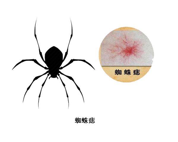 对称性红斑角化症发病