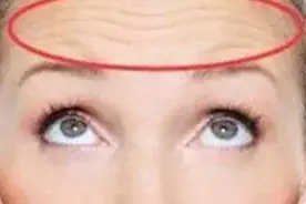 额头上有抬头纹？这几样东西混一起抹一抹，抬头纹慢慢就消失了视频封面