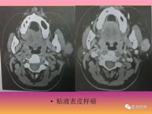 腮腺角化型鳞癌