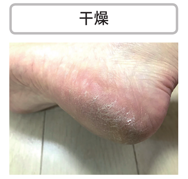 角化过度型足癣脂肪肝