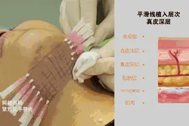 为什么45岁后面部松弛重的人，我不建议做线雕图片