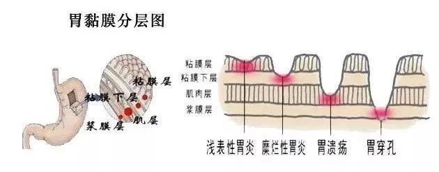 患了“慢性浅表性胃炎”：胃，你如何才能更健康？