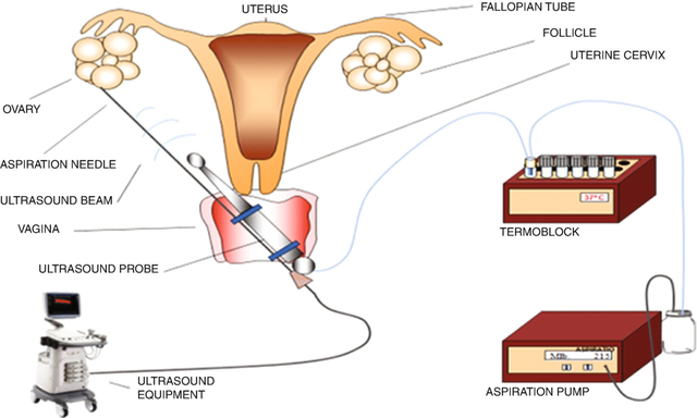 取卵后喝板栗花胶乌鸡汤吗 取卵后喝板栗花胶乌鸡汤吗有影响吗