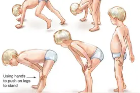 肌营养不良疾病都分有什么类型呢？图片