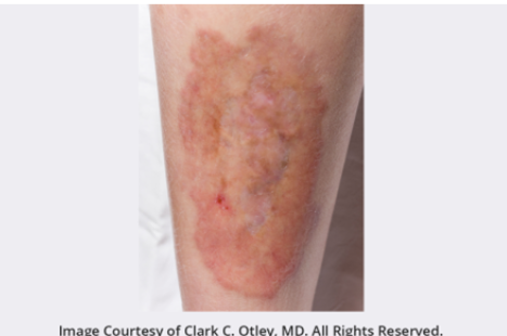 角化过度角化不全炎症