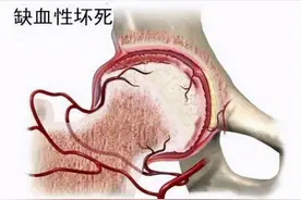 孩子腿疼，小心是得了儿童股骨头缺血性坏死图片