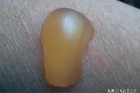 警惕，别把烫伤当“灸花”图片