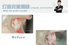 牙齿地包天矫正图片