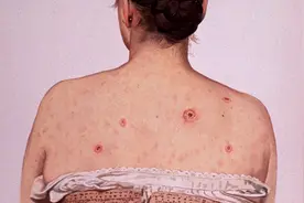 梅毒：遍体起红疹，片片似梅花图片