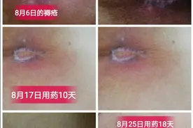 难言的痔疮，不用再发愁了！图片