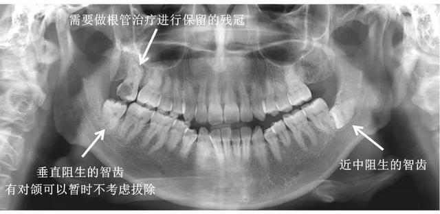 小伙拔牙10天后脑出血死亡！拔牙前后的这些忠告，一定要看