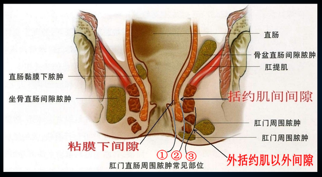 肛周脓肿要手术吗？