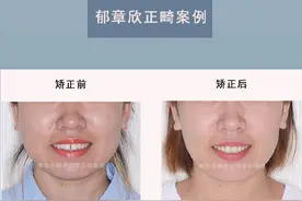 青岛牙套：「前牙开颌」舌侧矫正案例图片