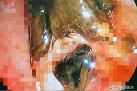 80岁老人驼背严重只能左侧卧位增加手术难度，做完手术医生湿透图片