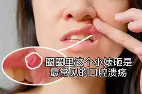 口腔溃疡补维C就好？你一定还不知道这些图片
