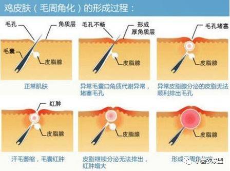 皮肤毛孔堵塞长鸡皮疙瘩