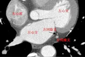 心脏冠脉（CTA）解剖--精品图集图片