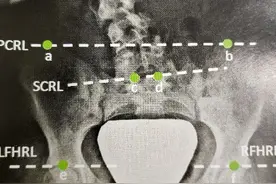 骨盆倾斜的测量图片