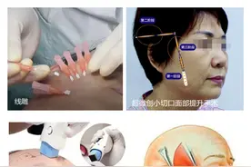 扒一扒“大拉皮手术、热玛吉、线雕与超微创小切口提升手术”图片