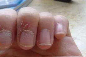 手指经常长倒刺，是缺乏维生素C吗？医生：这样处理才正确图片