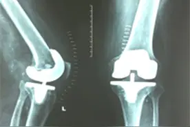 膝关节置换术后康复指导图片