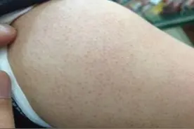 “鸡皮肤”你有吗？图片