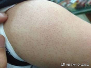 鸡皮肤在脖子上用什么药