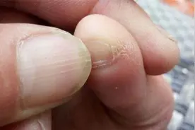 那些小脚趾指甲长成两瓣的人，到底是什么来头？图片