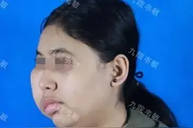Steiner综合征“半面”维族女孩也能变很美图片