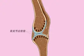 骨关节炎服用氨糖有助于改善病情，但2类人不适用，没必要乱吃图片