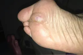 刻骨铭心的“腰麻”体验～记录两次真实的手术经历图片