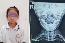 中医推拿治疗小儿斜颈有独到优势，一周即有明显改善图片