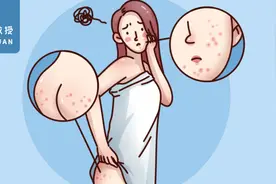 屁股上长痘是怎么回事？这4个地方长痘的真相，你早该知道了图片