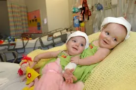 罕见连体婴的形成是一个生命还是两个生命？孕期多久可以查出来？图片