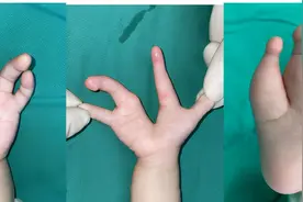 揪心！一岁半孩子手脚像“龙虾钳子”，医生都被惊到了图片